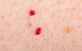 علت بروز خال قرمز از چیست؟